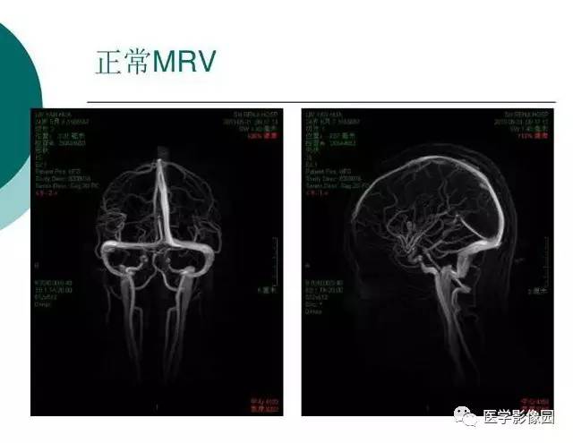 【PPT】脑血管病变影像诊断以及病例读片
