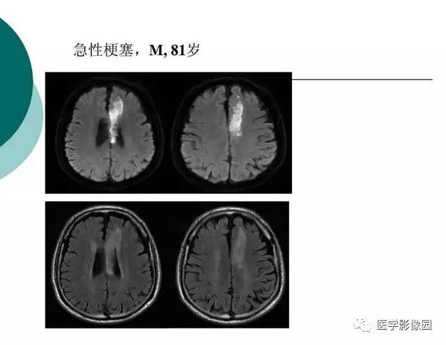 【PPT】脑血管病变影像诊断以及病例读片