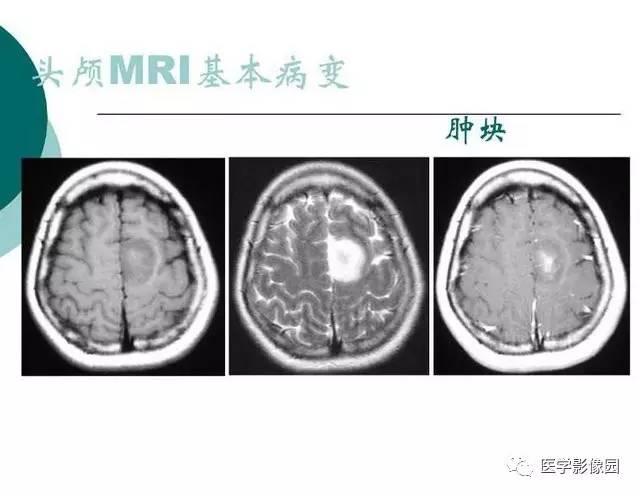 【PPT】脑血管病变影像诊断以及病例读片