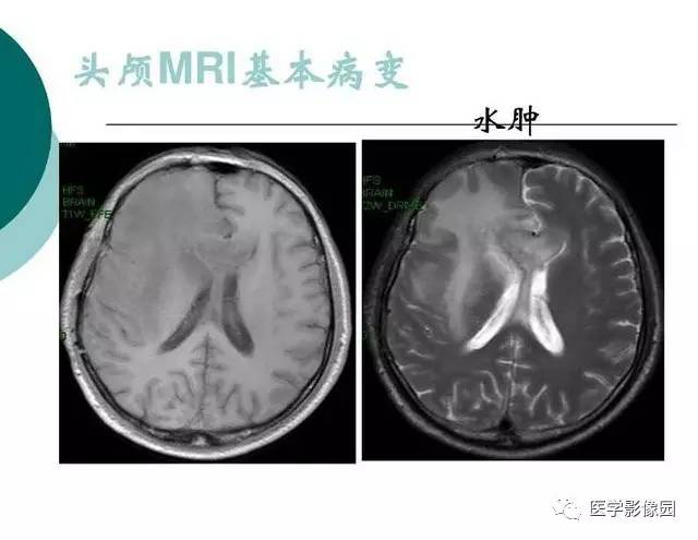 【PPT】脑血管病变影像诊断以及病例读片