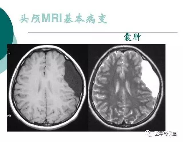 【PPT】脑血管病变影像诊断以及病例读片