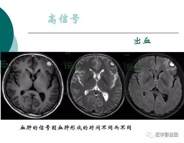 【PPT】脑血管病变影像诊断以及病例读片