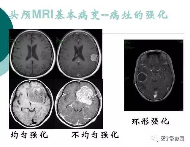【PPT】脑血管病变影像诊断以及病例读片