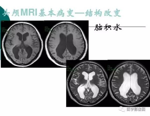 【PPT】脑血管病变影像诊断以及病例读片