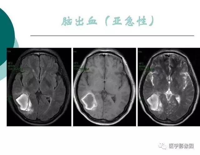 【PPT】脑血管病变影像诊断以及病例读片