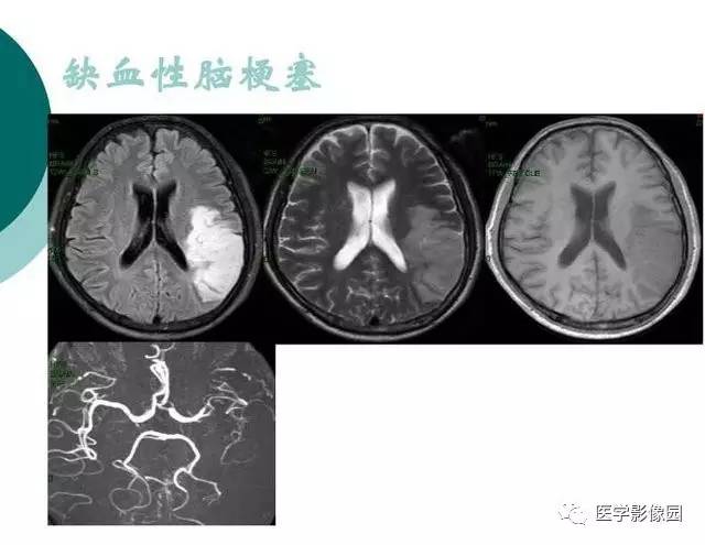 【PPT】脑血管病变影像诊断以及病例读片