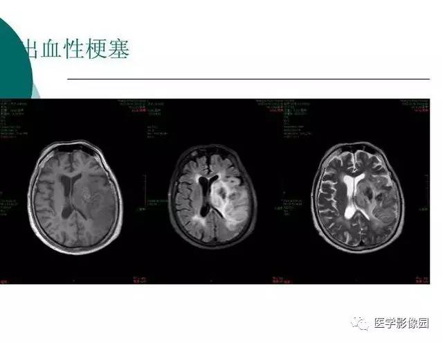 【PPT】脑血管病变影像诊断以及病例读片