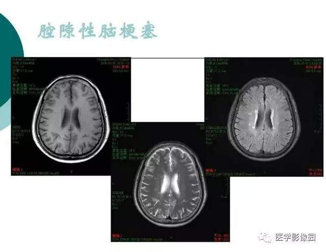 【PPT】脑血管病变影像诊断以及病例读片
