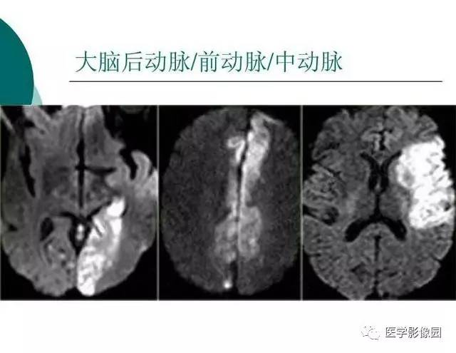 【PPT】脑血管病变影像诊断以及病例读片