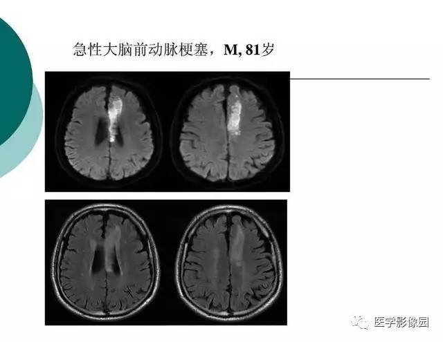【PPT】脑血管病变影像诊断以及病例读片