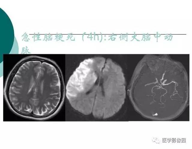 【PPT】脑血管病变影像诊断以及病例读片