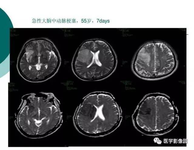【PPT】脑血管病变影像诊断以及病例读片