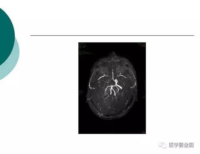 【PPT】脑血管病变影像诊断以及病例读片