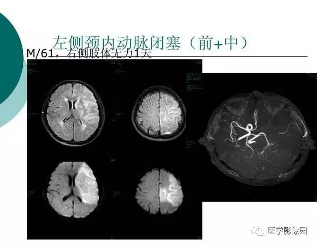 【PPT】脑血管病变影像诊断以及病例读片
