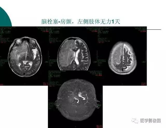 【PPT】脑血管病变影像诊断以及病例读片