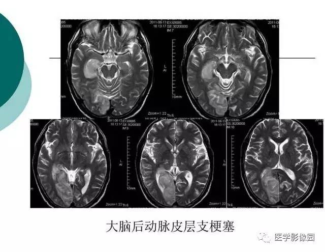 【PPT】脑血管病变影像诊断以及病例读片