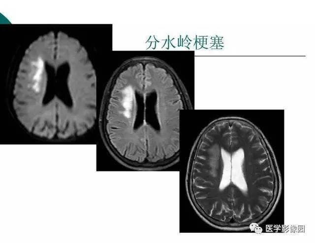 【PPT】脑血管病变影像诊断以及病例读片