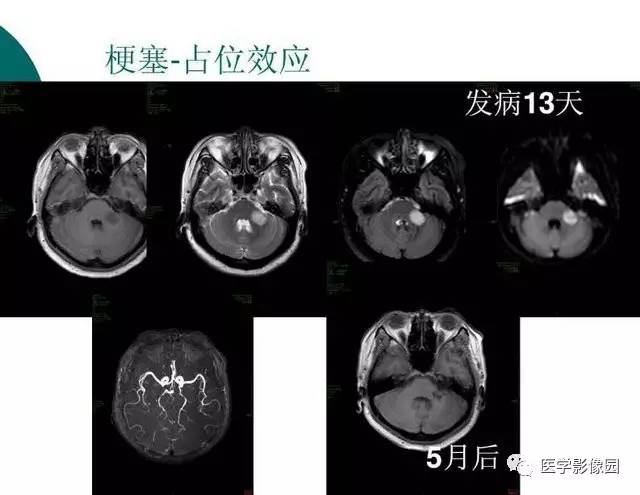【PPT】脑血管病变影像诊断以及病例读片