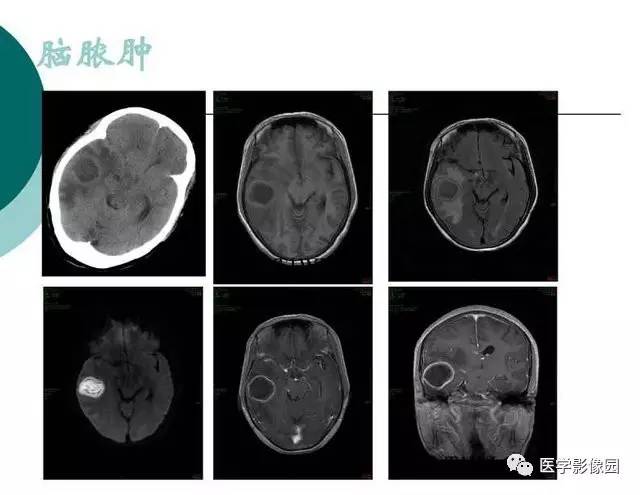 【PPT】脑血管病变影像诊断以及病例读片