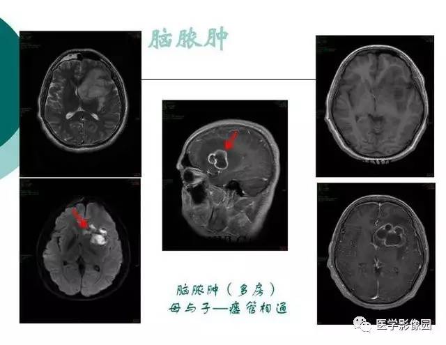 【PPT】脑血管病变影像诊断以及病例读片