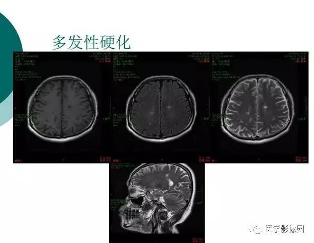 【PPT】脑血管病变影像诊断以及病例读片