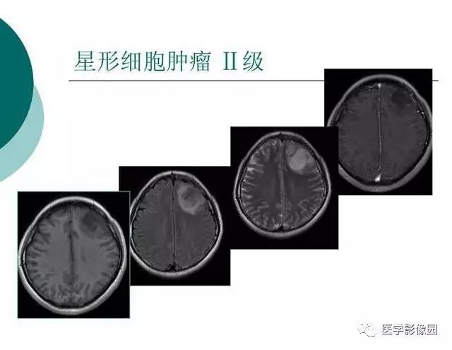 【PPT】脑血管病变影像诊断以及病例读片