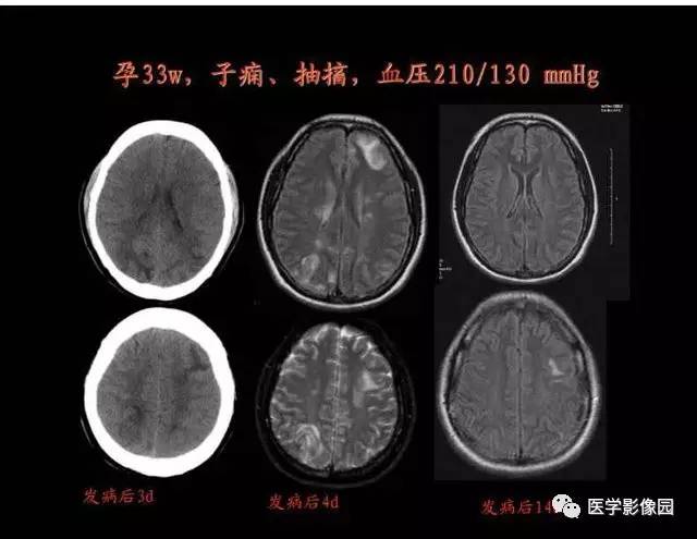 【PPT】脑血管病变影像诊断以及病例读片