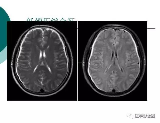【PPT】脑血管病变影像诊断以及病例读片