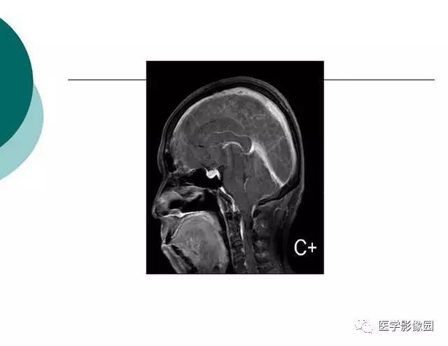 【PPT】脑血管病变影像诊断以及病例读片