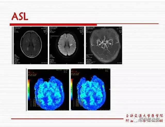 【PPT】脑血管病变影像诊断以及病例读片