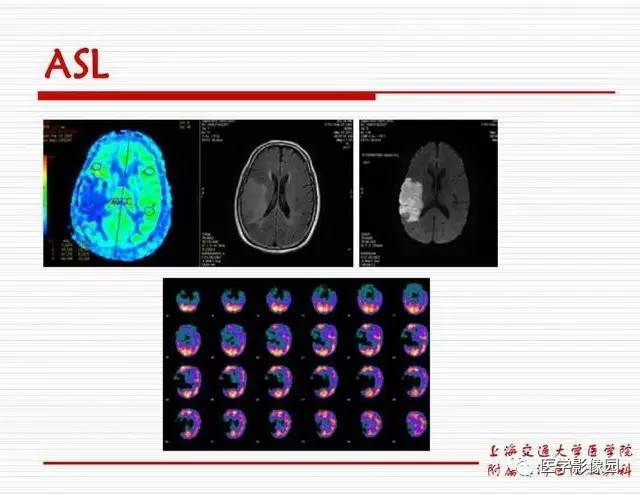 【PPT】脑血管病变影像诊断以及病例读片