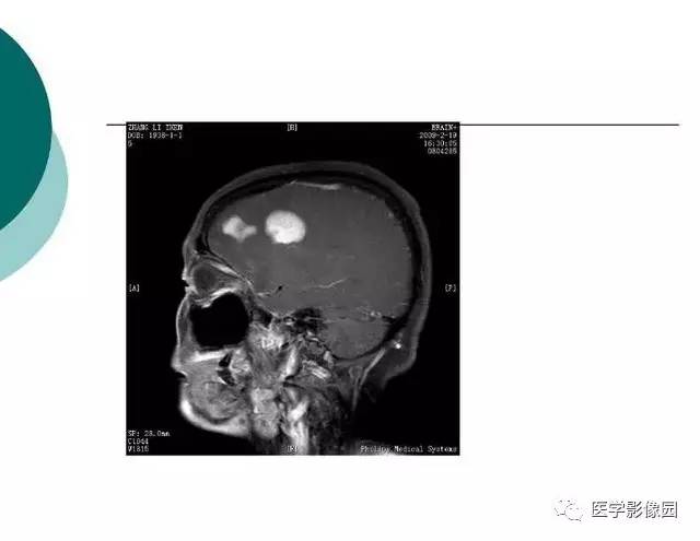【PPT】脑血管病变影像诊断以及病例读片