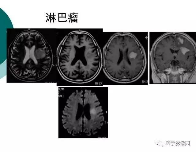 【PPT】脑血管病变影像诊断以及病例读片
