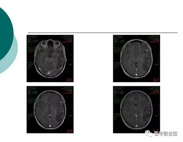 【PPT】脑血管病变影像诊断以及病例读片