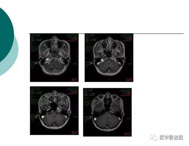 【PPT】脑血管病变影像诊断以及病例读片