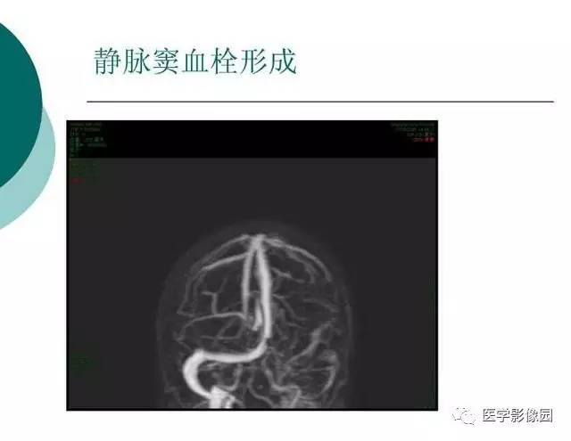 【PPT】脑血管病变影像诊断以及病例读片
