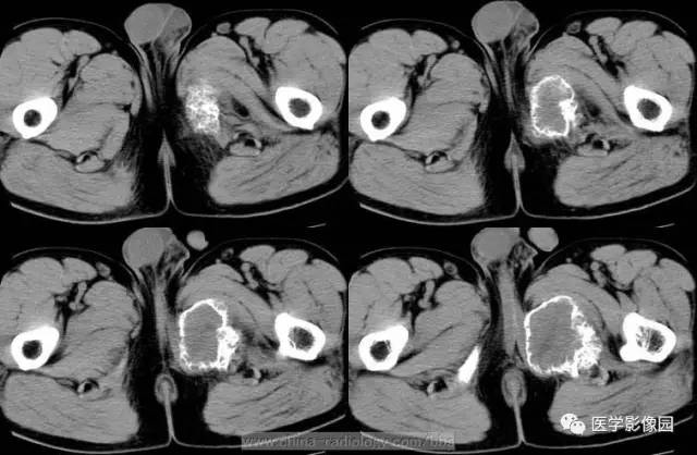 【病例】少见部位的非骨化性纤维瘤1例CT 【病例】少见部位的非骨化性纤维瘤1例CT