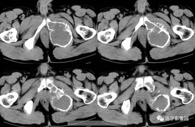 【病例】少见部位的非骨化性纤维瘤1例CT 【病例】少见部位的非骨化性纤维瘤1例CT