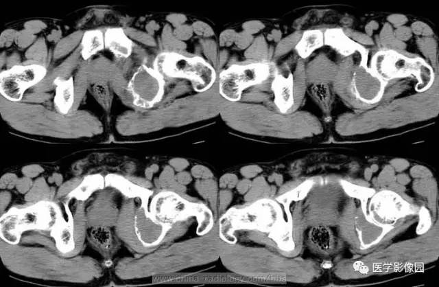 【病例】少见部位的非骨化性纤维瘤1例CT 【病例】少见部位的非骨化性纤维瘤1例CT