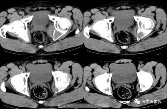 【病例】少见部位的非骨化性纤维瘤1例CT 【病例】少见部位的非骨化性纤维瘤1例CT