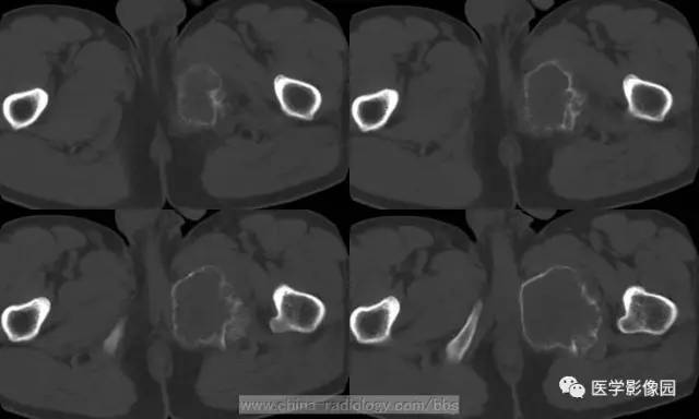 【病例】少见部位的非骨化性纤维瘤1例CT 【病例】少见部位的非骨化性纤维瘤1例CT