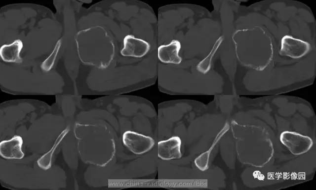 【病例】少见部位的非骨化性纤维瘤1例CT 【病例】少见部位的非骨化性纤维瘤1例CT