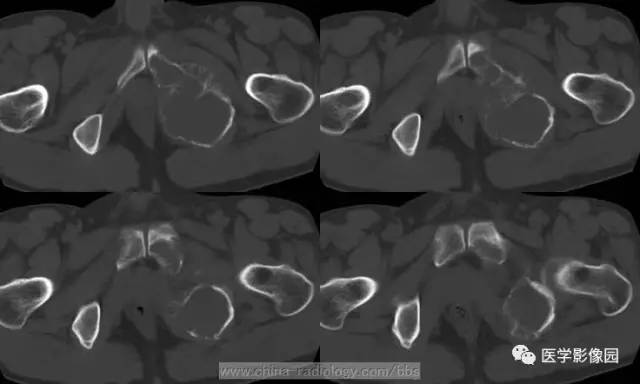 【病例】少见部位的非骨化性纤维瘤1例CT 【病例】少见部位的非骨化性纤维瘤1例CT