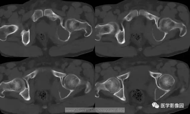 【病例】少见部位的非骨化性纤维瘤1例CT 【病例】少见部位的非骨化性纤维瘤1例CT