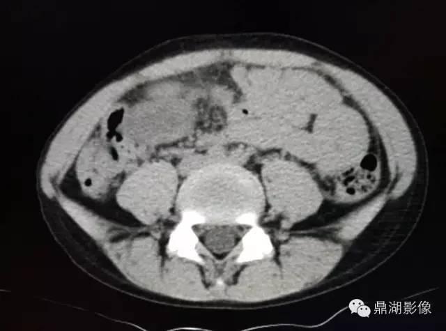 【病例】美克尔憩室(Meckels diverticulum) 一例影像诊断 【病例】美克尔憩室(Meckels diverticulum) 一例影像诊断