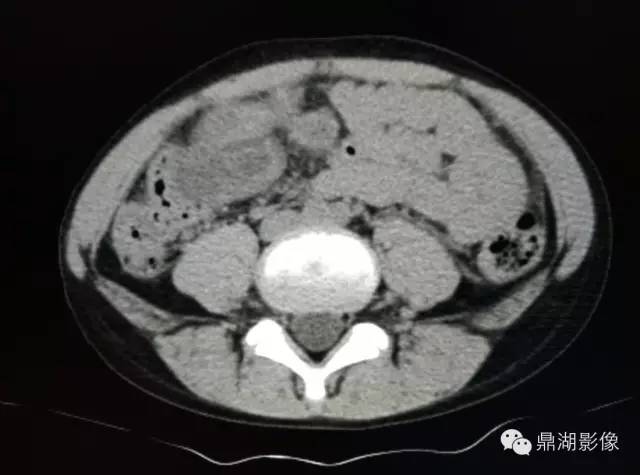 【病例】美克尔憩室(Meckels diverticulum) 一例影像诊断 【病例】美克尔憩室(Meckels diverticulum) 一例影像诊断