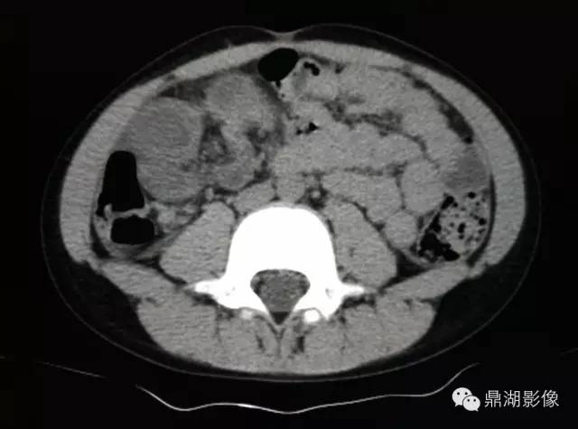 【病例】美克尔憩室(Meckels diverticulum) 一例影像诊断 【病例】美克尔憩室(Meckels diverticulum) 一例影像诊断