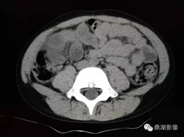 【病例】美克尔憩室(Meckels diverticulum) 一例影像诊断 【病例】美克尔憩室(Meckels diverticulum) 一例影像诊断