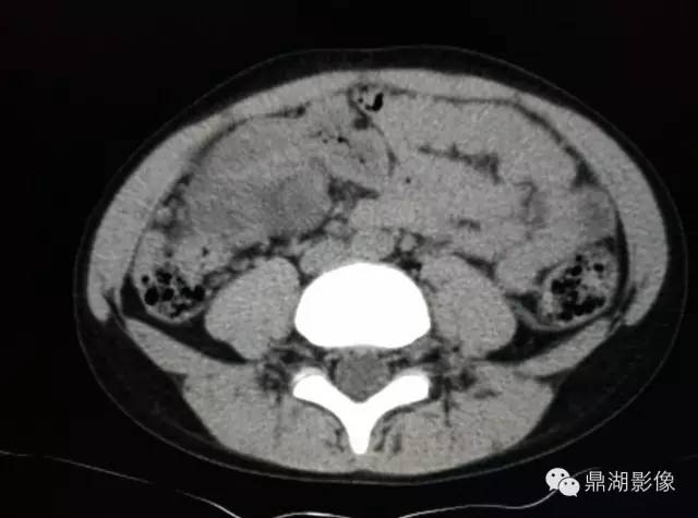 【病例】美克尔憩室(Meckels diverticulum) 一例影像诊断 【病例】美克尔憩室(Meckels diverticulum) 一例影像诊断