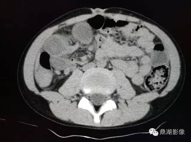【病例】美克尔憩室(Meckels diverticulum) 一例影像诊断 【病例】美克尔憩室(Meckels diverticulum) 一例影像诊断